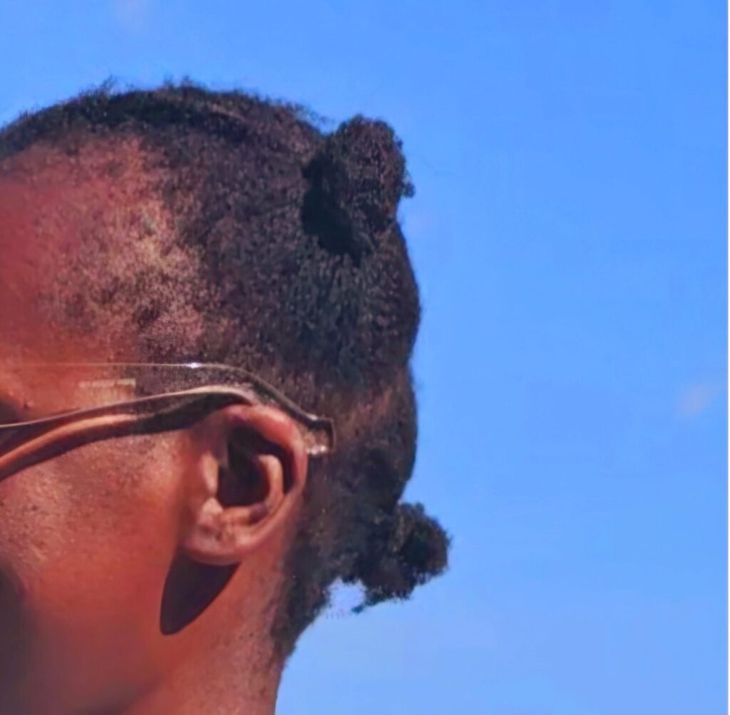 Traction Alopecia